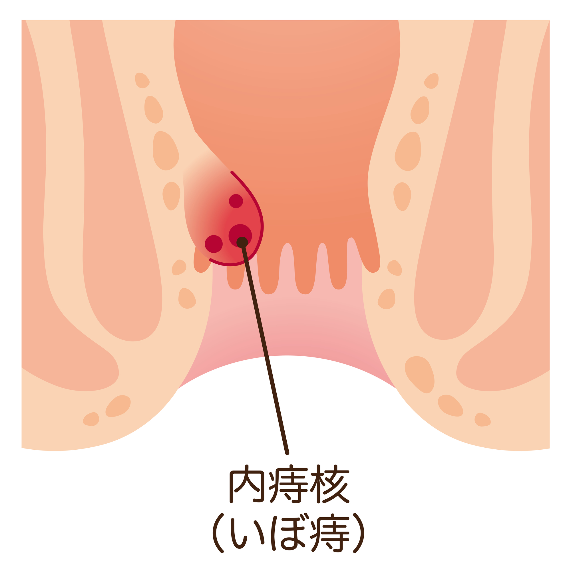 痔核(いぼ痔)