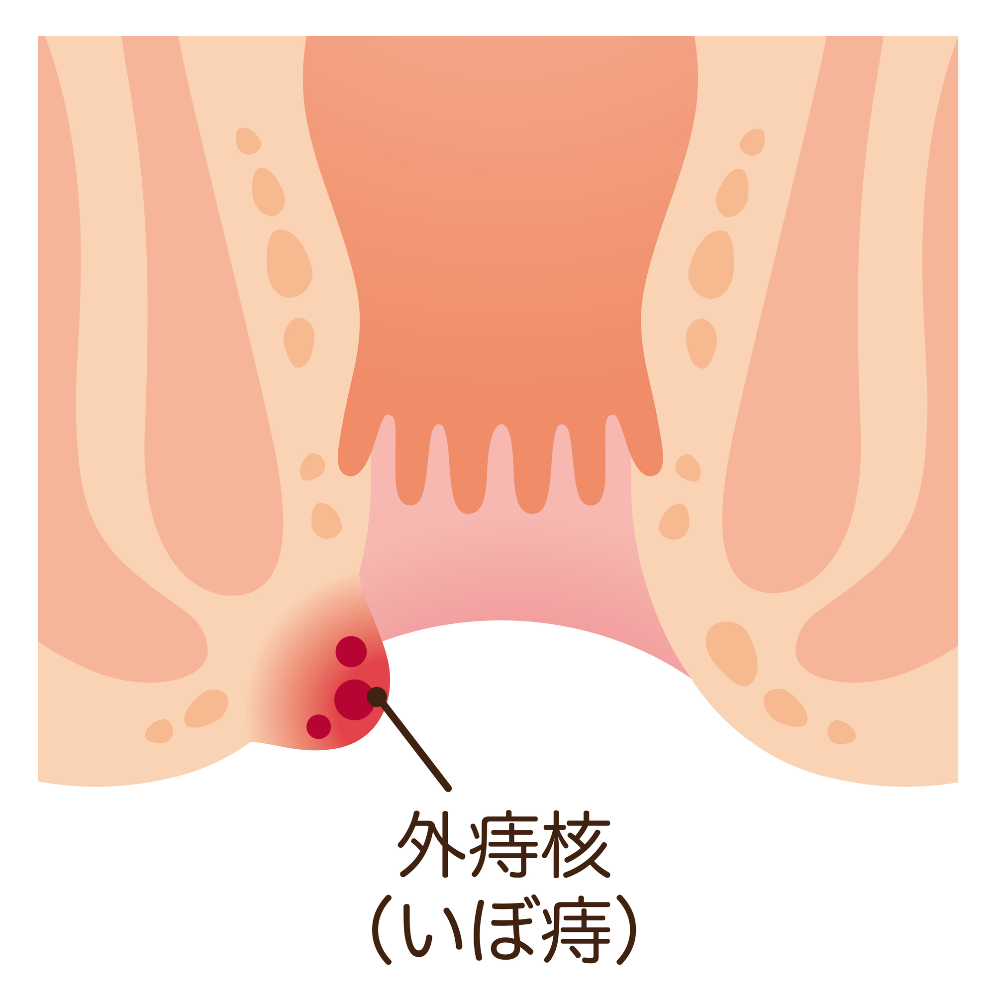 痔核(いぼ痔)