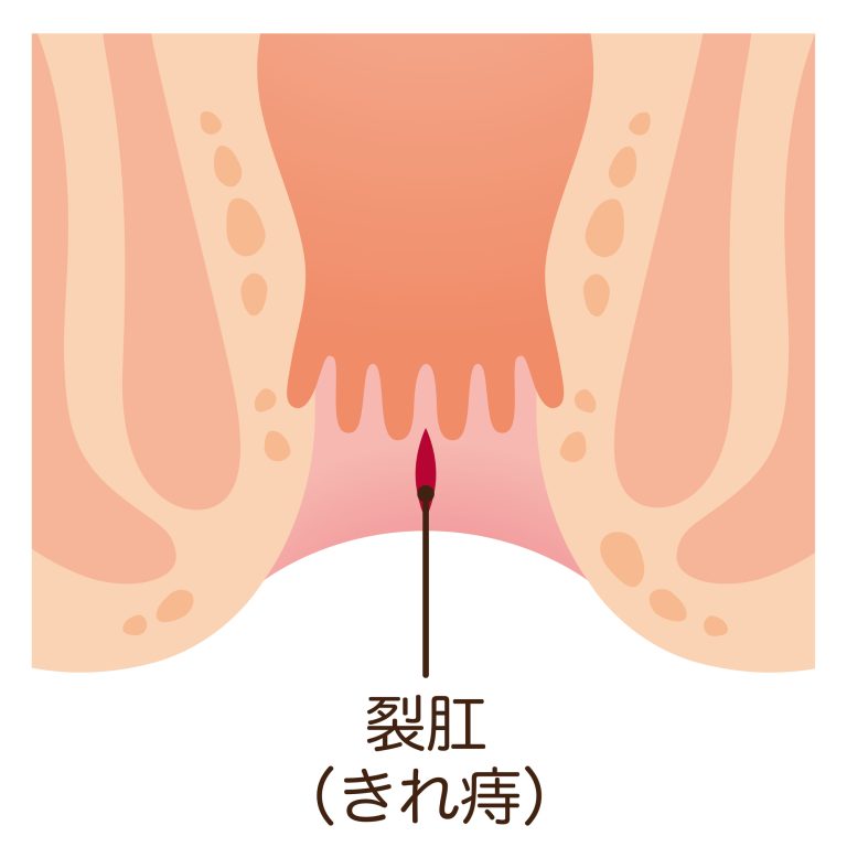 切れ痔