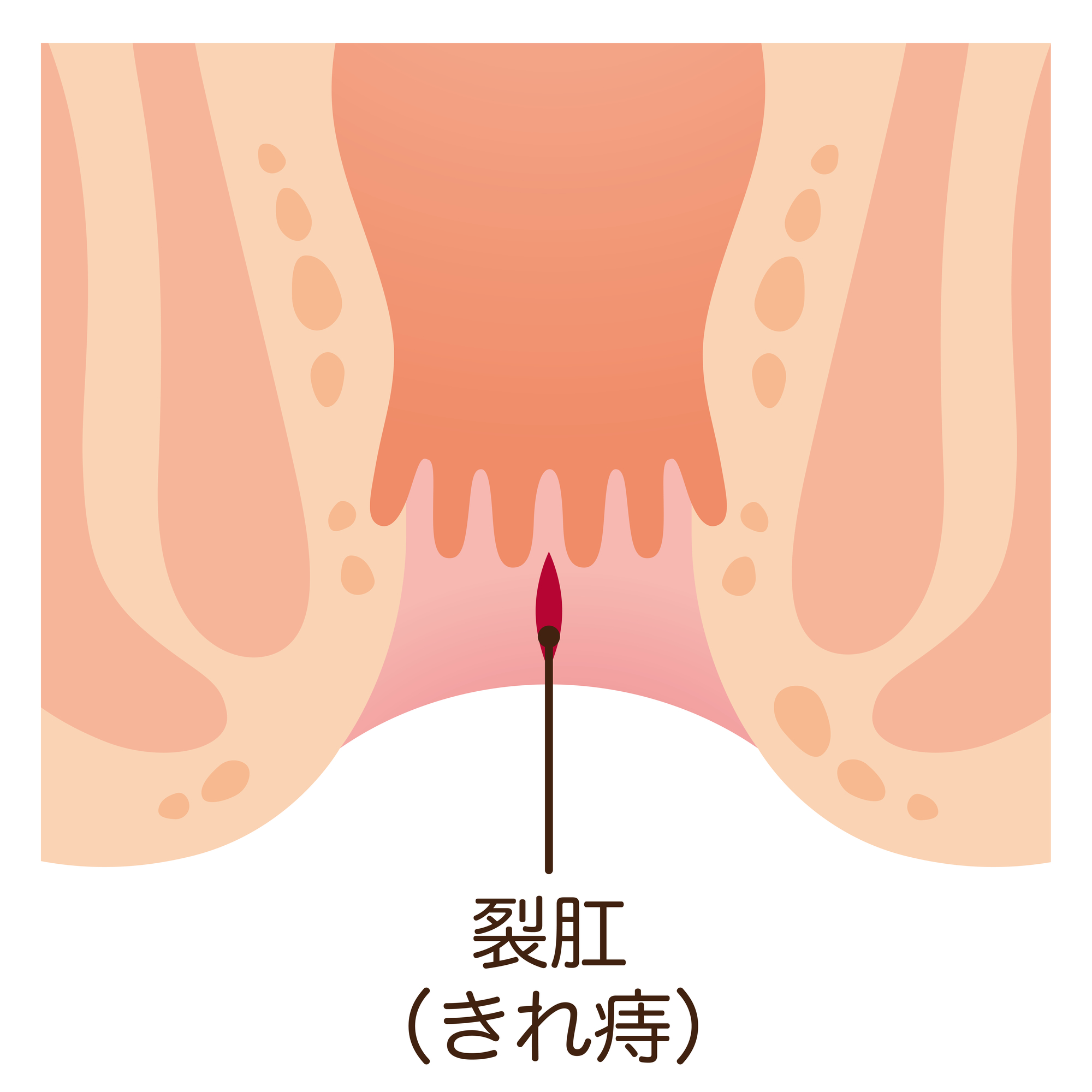 切れ痔（裂肛）